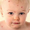 Аллергия на комариные укусы у ребенка
