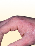 Картинка-анонс к статье Симптомы и лечение грибковой аллергии