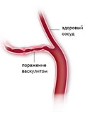 Картинка-анонс к статье Симптомы и лечение аллергического васкулита