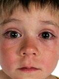 Картинка-анонс к статье Лечение отеков под глазами у ребенка