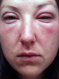 Картинка-анонс к статье Последствие аллергии. Отек лица