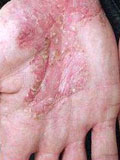 Картинка-анонс к статье Симптомы и лечение экзематозного дерматита