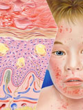 Картинка-анонс к статье Что такое вирусный дерматит?