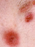 Картинка-анонс к статье Все об инфекционном дерматите