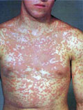Картинка-анонс к статье Все о токсическом дерматите