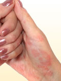 Картинка-анонс к статье Симптомы псориаза на руках