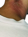 Картинка-анонс к статье Лечение экземы на шее