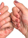 Картинка-анонс к статье Симптомы и лечение дисгидроза кистей рук