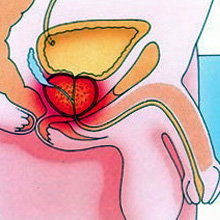 Картинка-анонс к статье Хронический простатит: зачем терпеть, когда можно лечить?