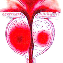 Картинка-анонс к статье Острый простатит: причины возникновения и прогноз излечения