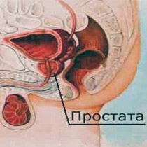 Картинка-анонс к статье Опасность небактериального простатита и методы его лечения