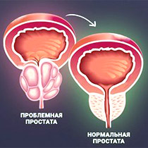 Картинка-анонс к статье Причины развития и симпотоматика застойного простатита