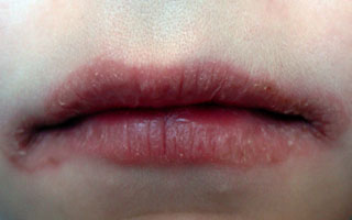 Воспаление губ