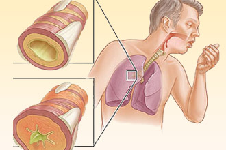 Бронхиальная астма