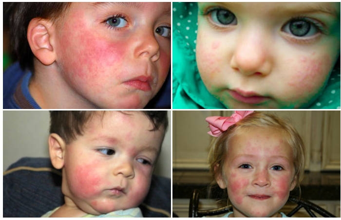 Фото пищевой аллергии у детей