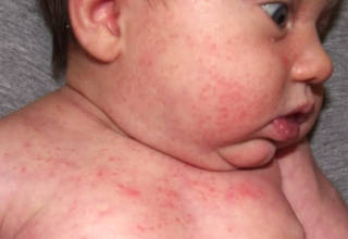Аллергия у ребенка на все мясо thumbnail