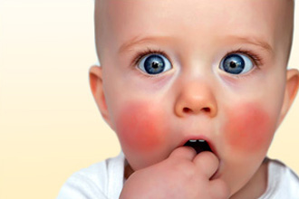 Причины аллергии на щеках у детей