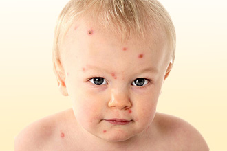 Симптомы аллергии у детей  