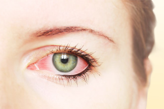 Покраснение глаз - проявление аллергии 
