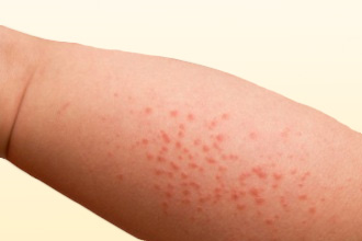 Сыпь - один из ключевых признаков проявления дерматита