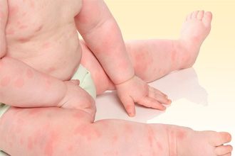 Козье молоко для новорожденных при аллергии thumbnail