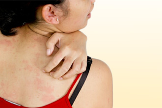 Сыпь - доминирующее проявление кожной аллергии