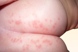Аллергия у младенца 